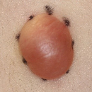 水疱型毛母腫